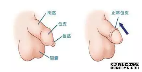 马鞍山当涂县从5方面带你认识包皮过长